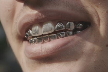 découvrez nos conseils pour éviter les irritations et douleurs causées par des grillz mal ajustés, et profitez d'un confort optimal tout en portant vos bijoux dentaires.